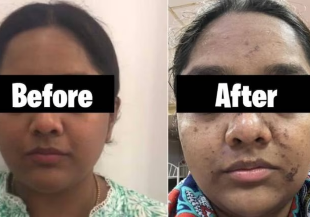 Mumbai: Woman faces skin burn after facial massage worth Rs 17,500