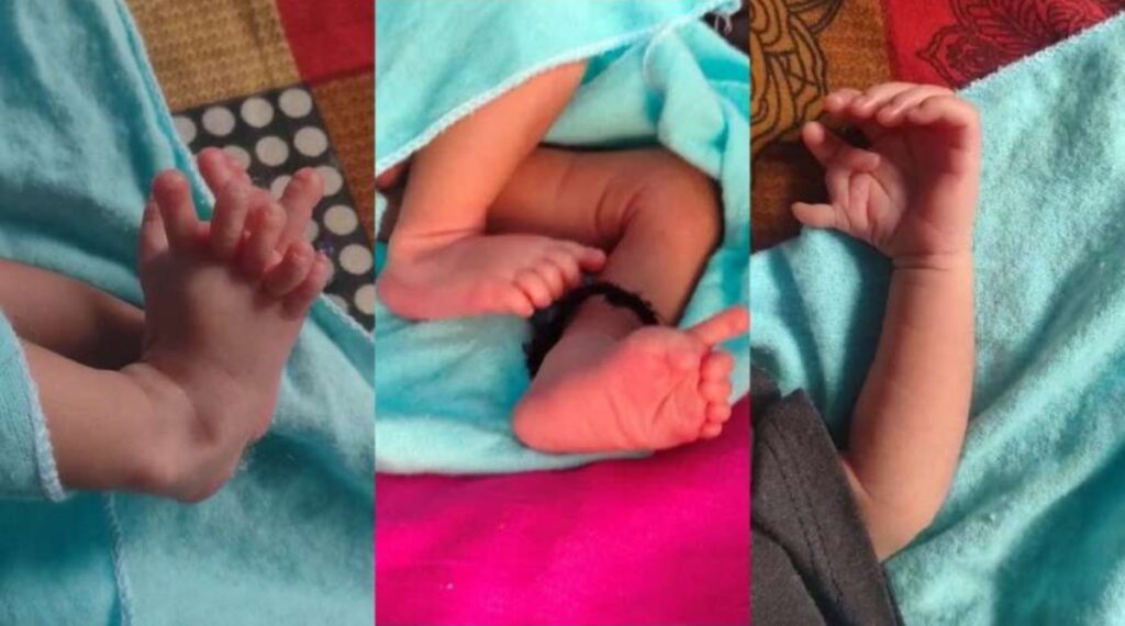 Baby with 26 fingers