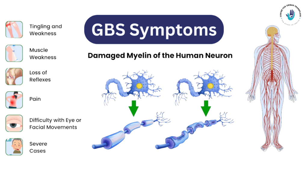 GBS Syndrome