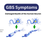 GBS Syndrome